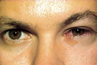 Photo of patient with Adenovirus infection