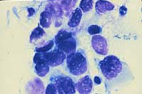 Giemsa stain of Masquerade syndrome