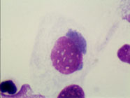 Giemsa stain of Chlamydial inclusion bodies