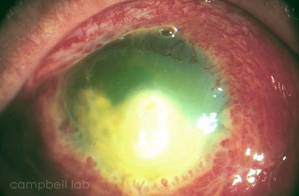 P.aeruginosa corneal ulcer