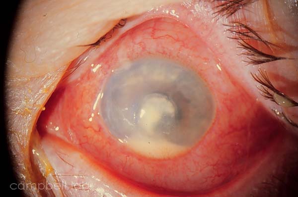 P. aeruginosa corneal ulcer