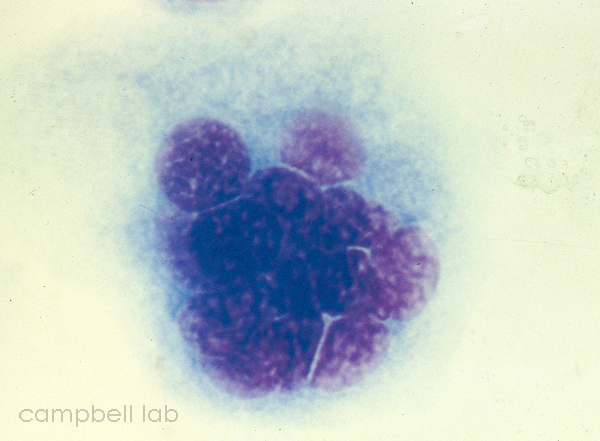 HSV multinucleated epithelial cell