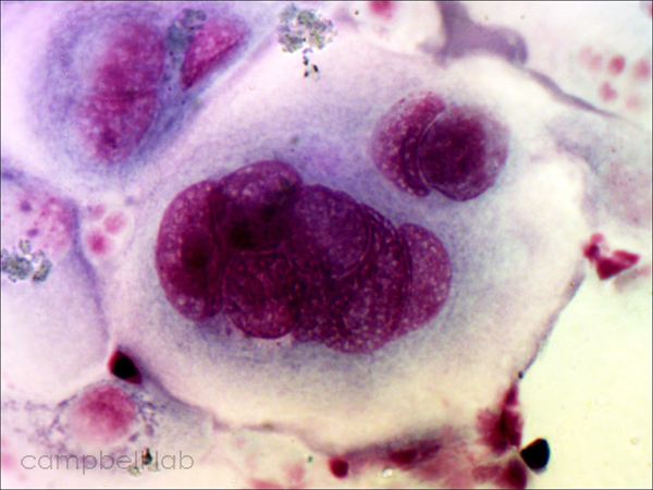 HSV multinucleated epithelial cell